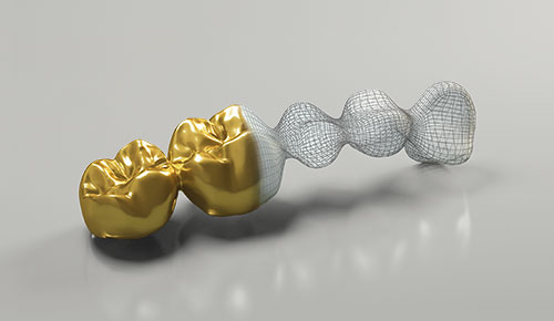 Fräsen in Edelmetall am Beispiel einer Dentalbrücke